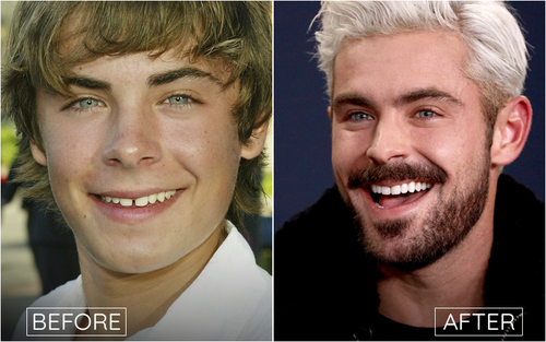 Dinții Zac Efron: Un Zâmbet Demn De İnvidiat