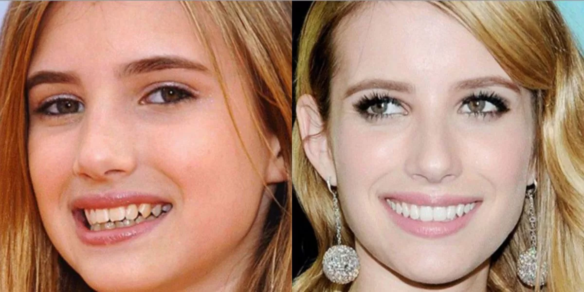 Emma Roberts Dişleri Öncesi ve Sonrası