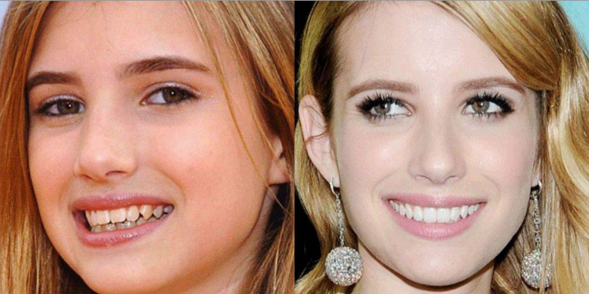 Emma Roberts Smile Before And After