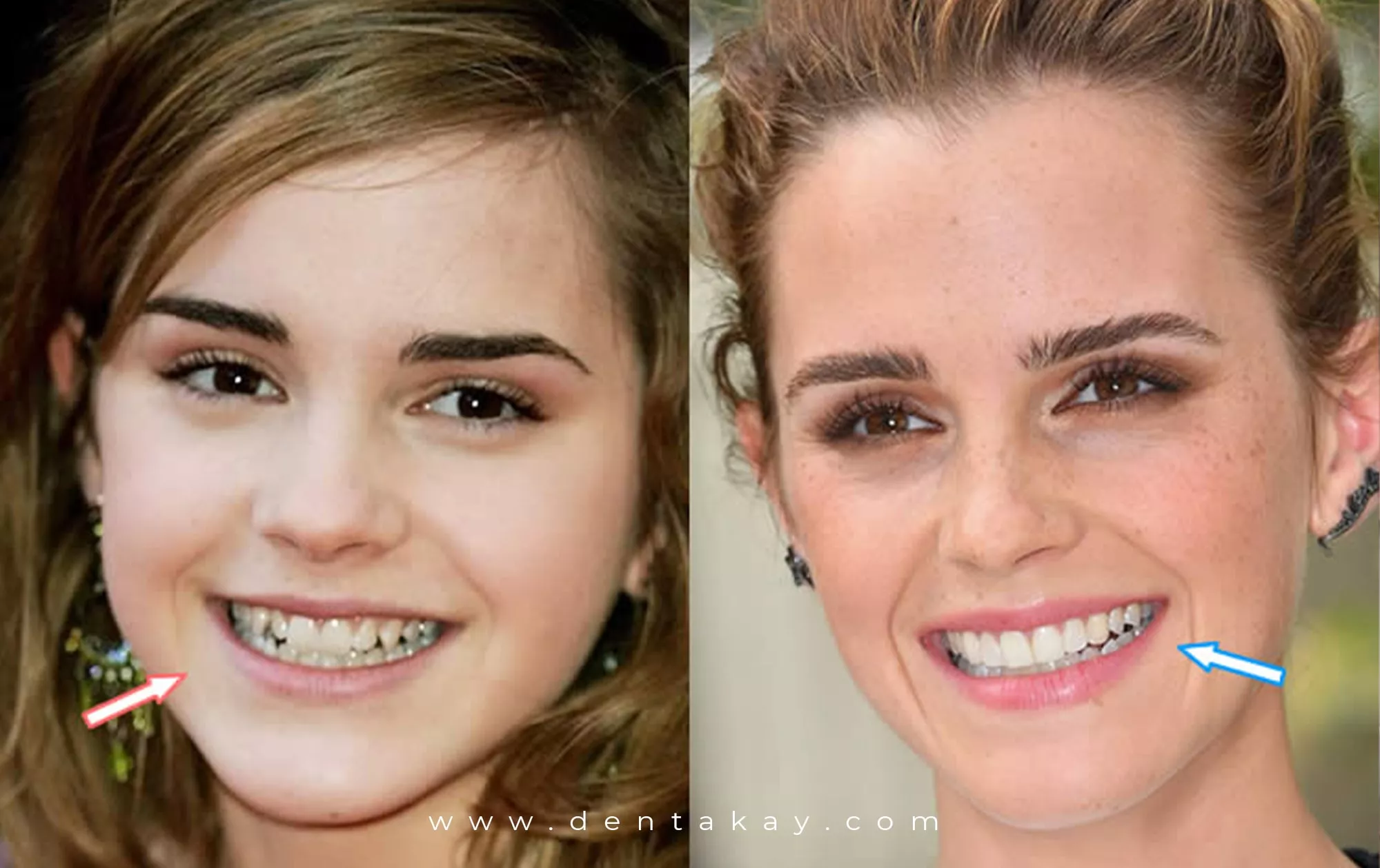 Emma Watson's Smile Before & After