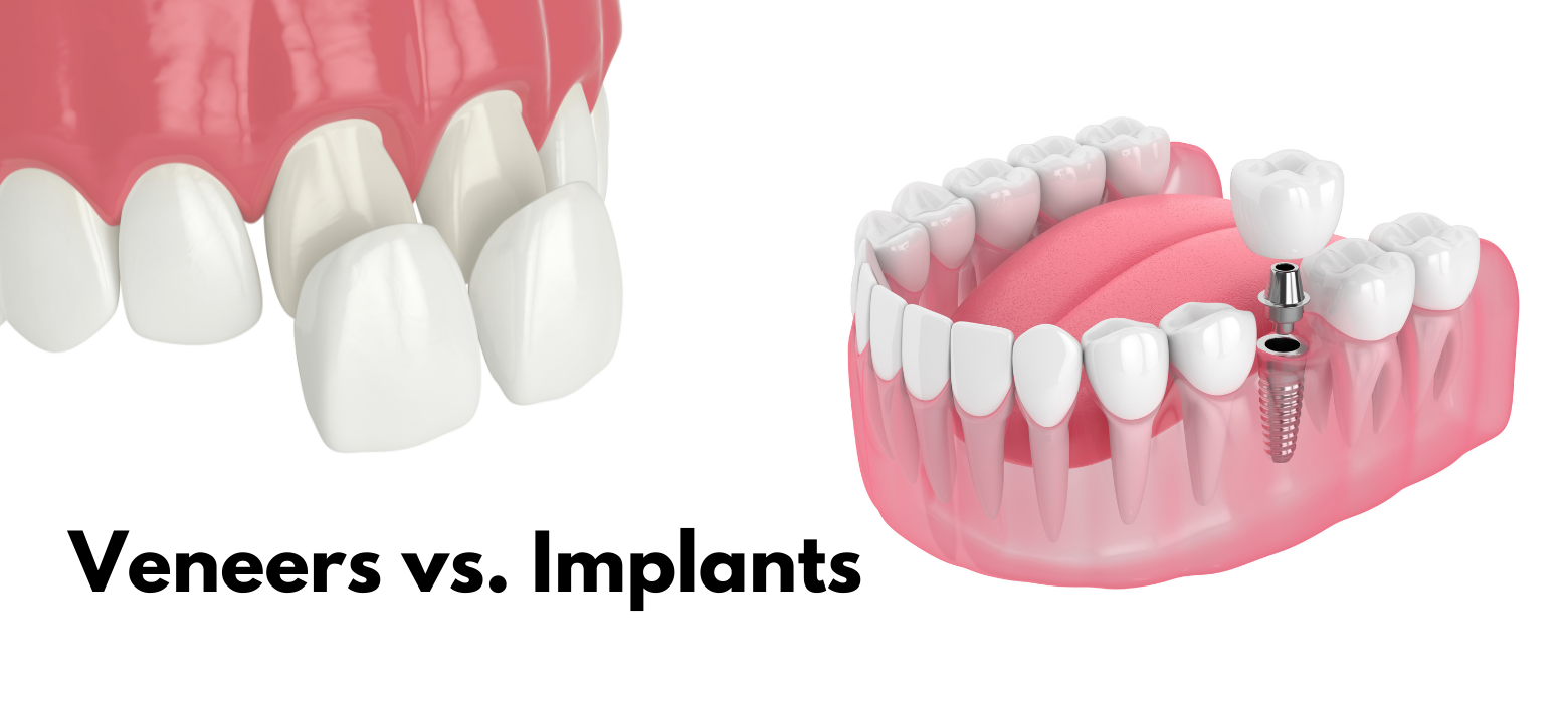 implantlar ve Lamineler