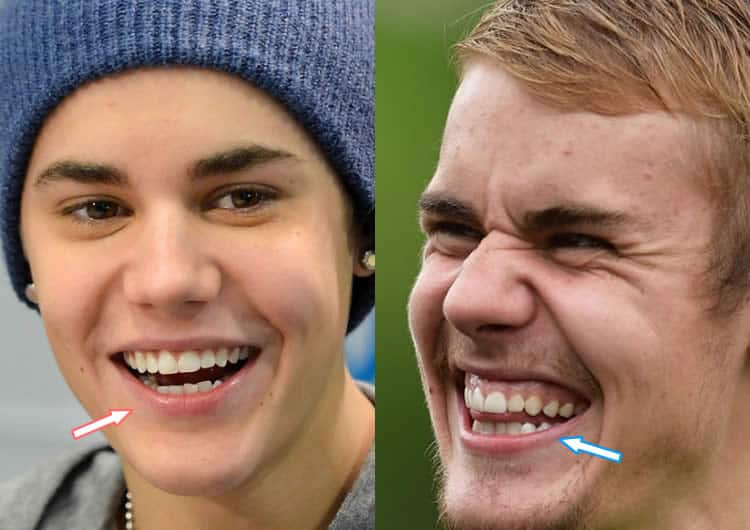 Justin Bieber's teeth before and after