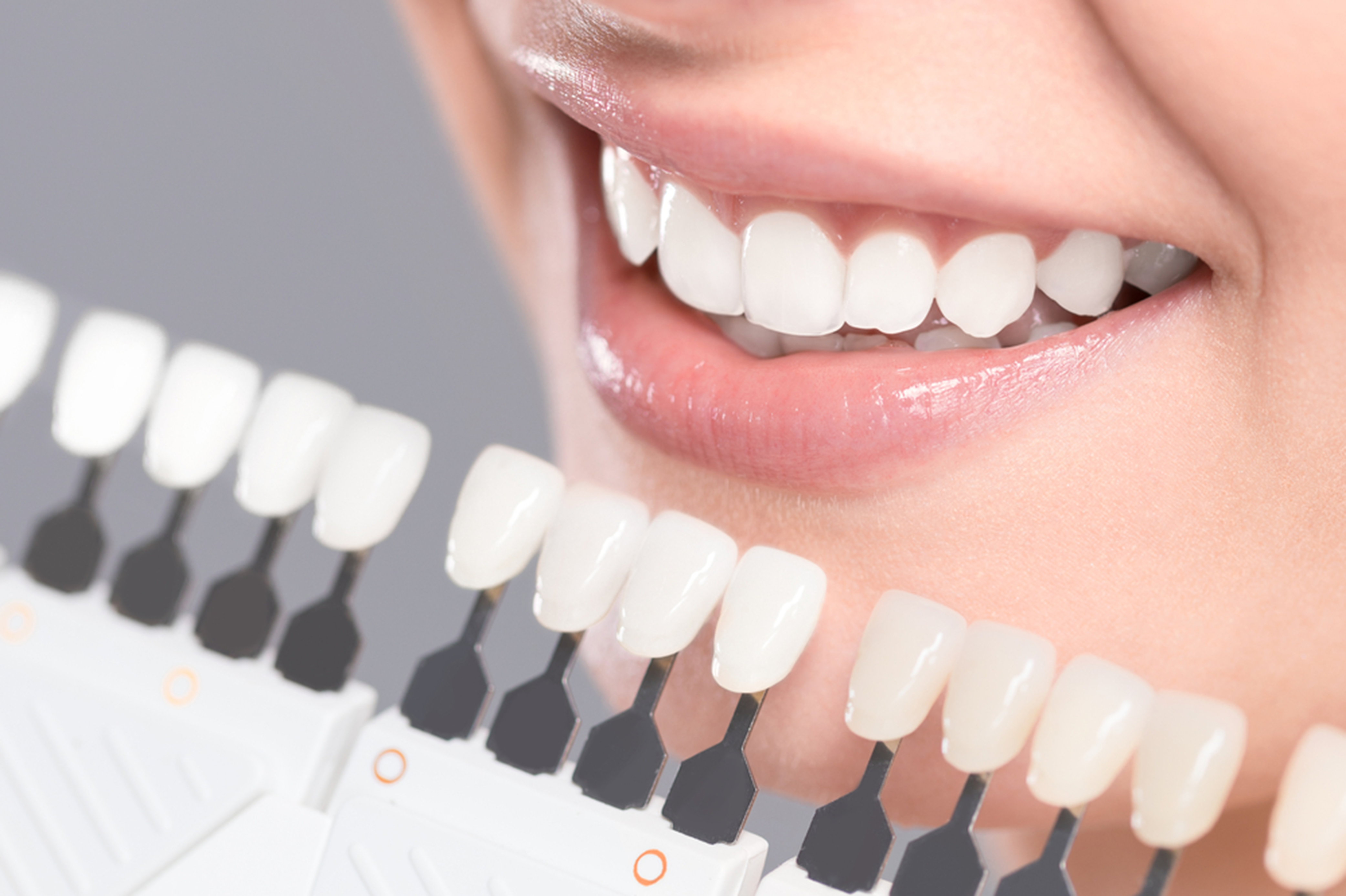Lucruri De Stiut Despre Furnirul Dentar Emax