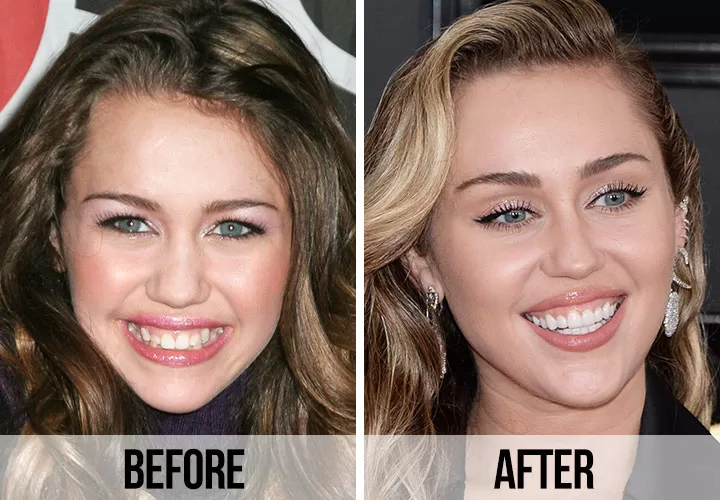 Miley Cyrus Diş İşlemlerinden Öncesi ve Sonrası