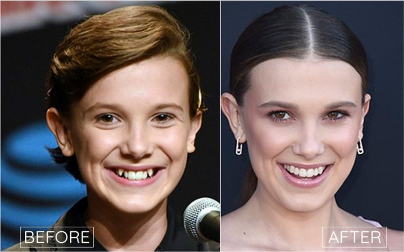 Millie Bobby Brown Gülüş Öncesi ve Sonrası