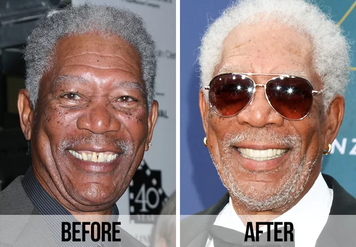Morgan Freeman Dişleri Öncesi ve Sonrası