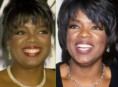 Oprah Winfrey's Smile Before And After