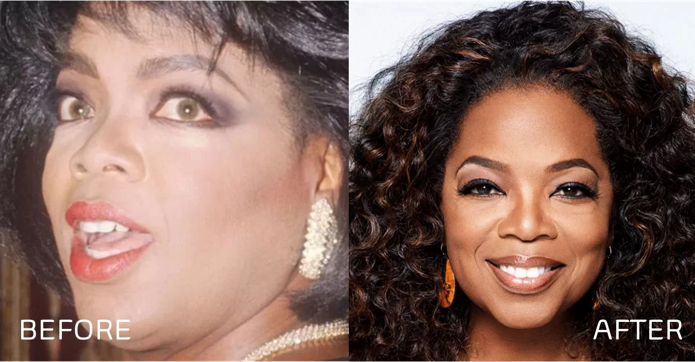 Oprah Winfrey Gülüşü Öncesi ve Sonrası