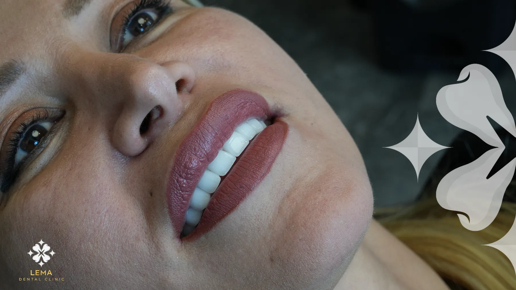 Quelle Marque D'implant Dentaire Devrais-je Préférer