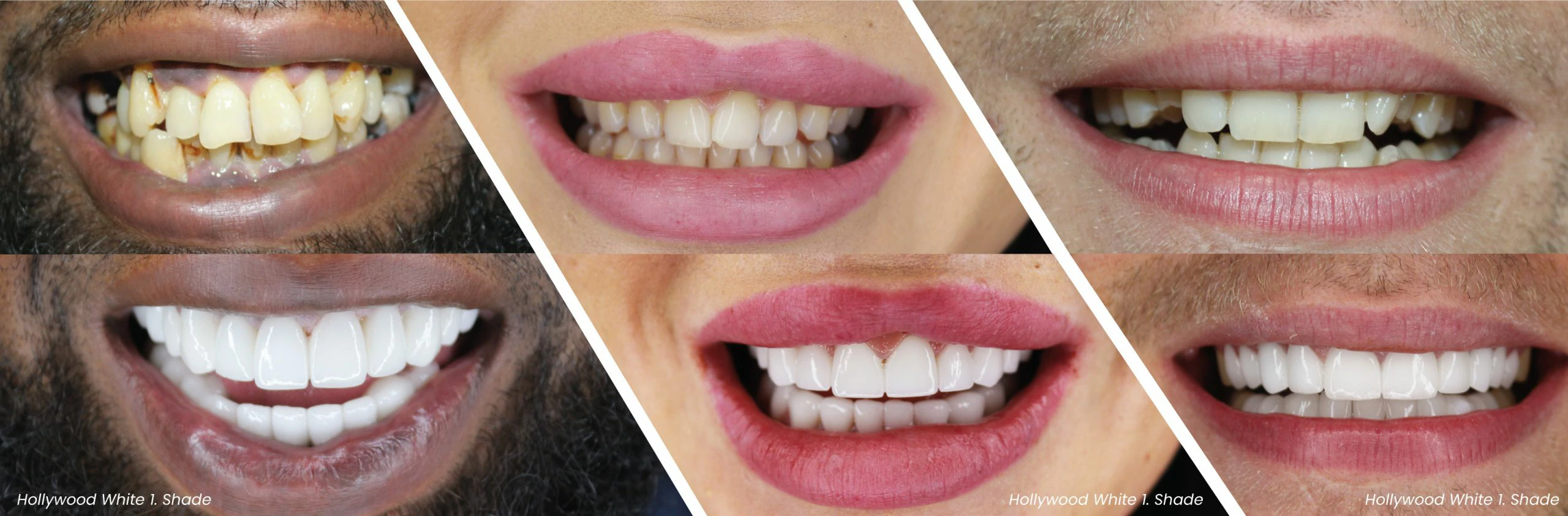 Wissenswertes über Emax Dental Veneer