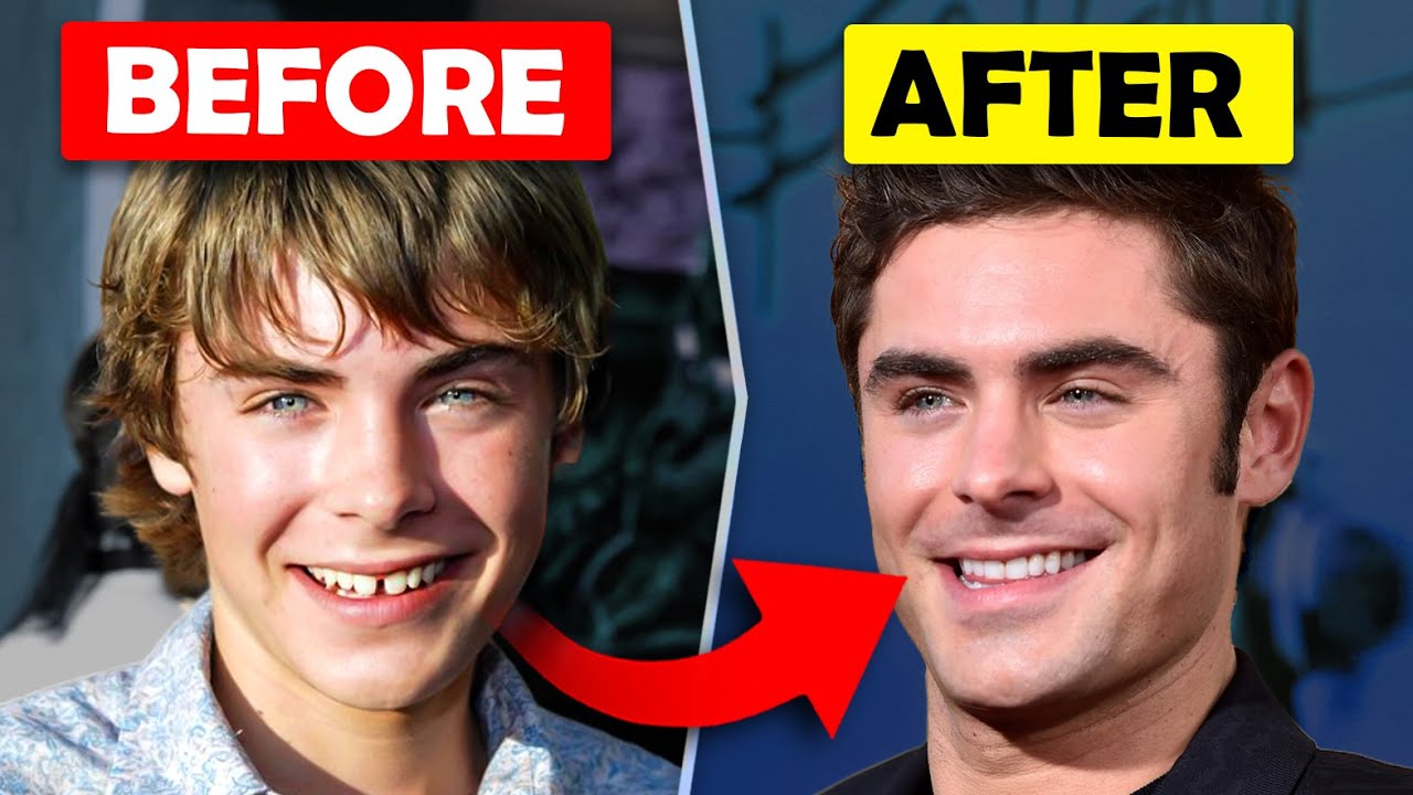 Zac Efron's Smile before and after