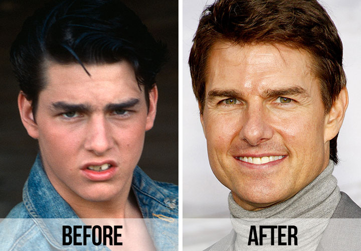 Tom Cruise'un Diş Öncesi ve Sonrası