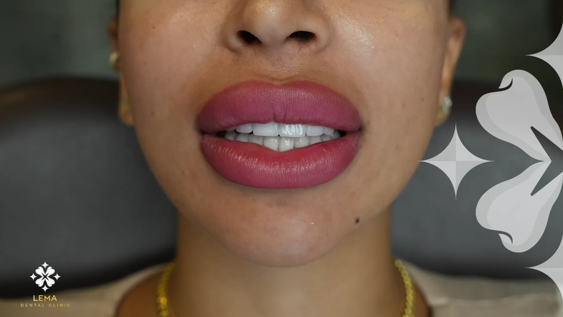 Les Implants Dentaires Font-ils Mal
