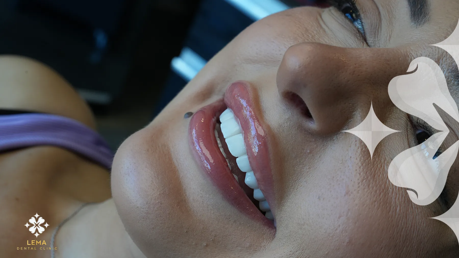 L'art D'un Sourire Parfait Un Aperçu De La Chirurgie Des İmplants Dentaires
