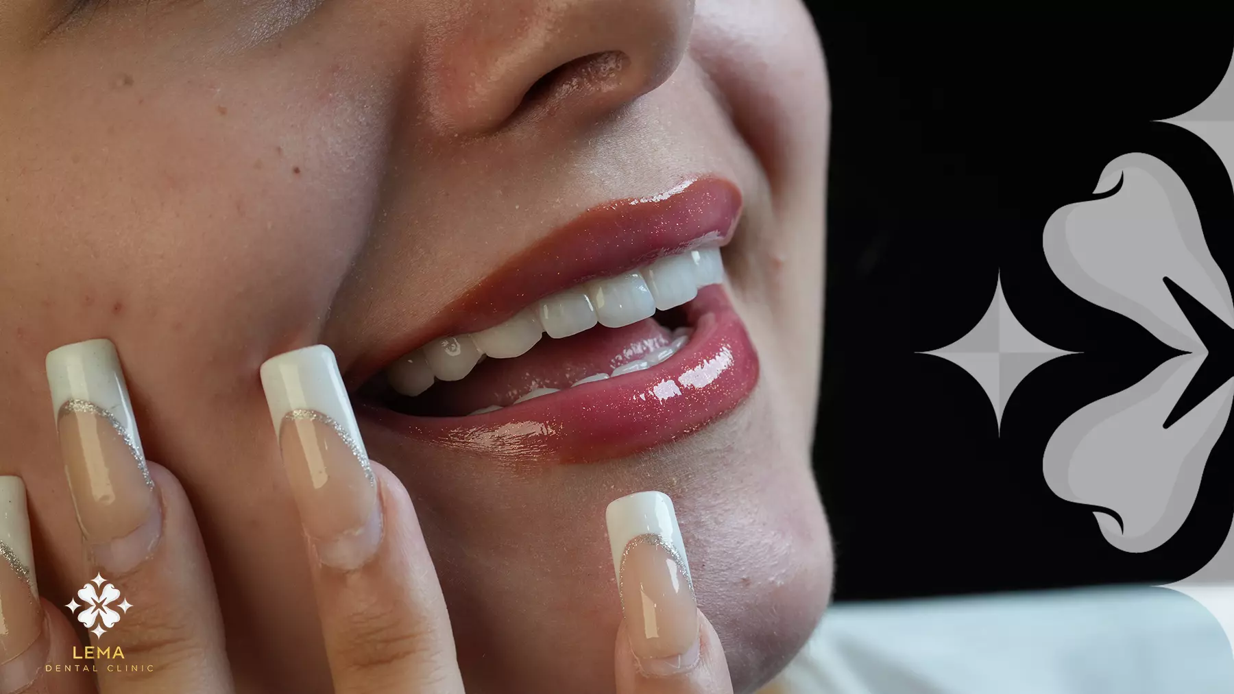 Pourquoi l'opération Gummy Smile Est-elle Effectuée