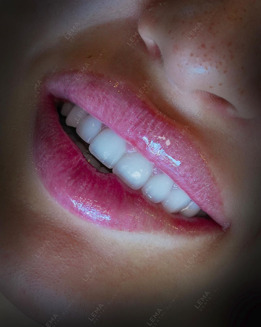 Dental Implants Lema Clinic