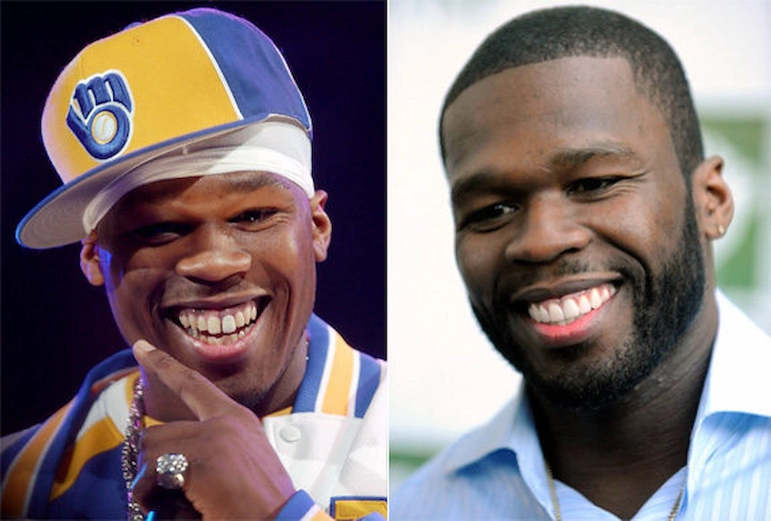 50 cent teeth before after