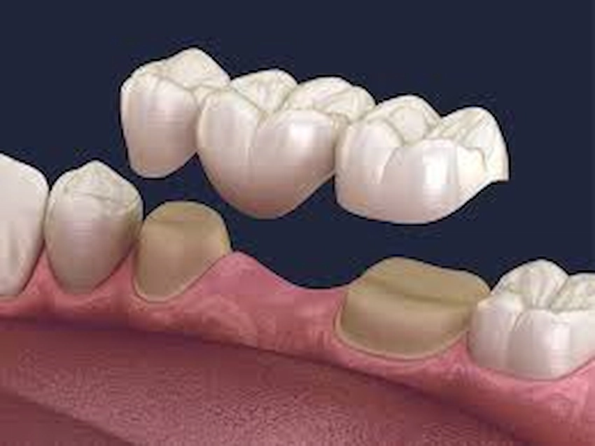 dental crowns