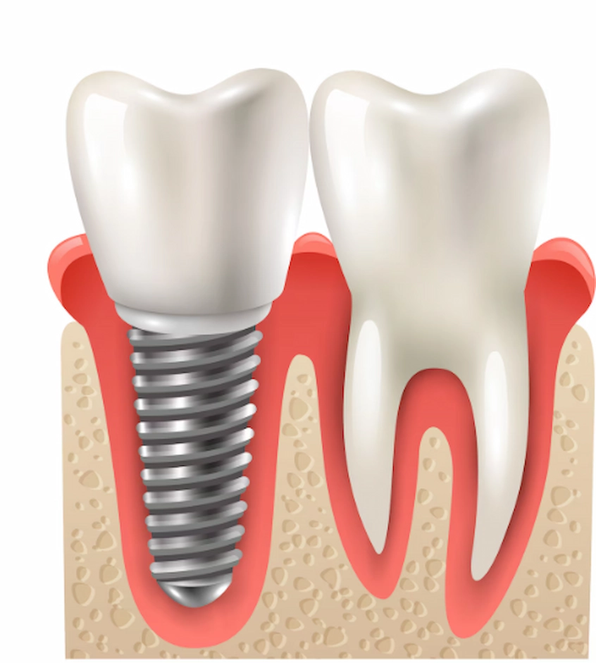 dental implant