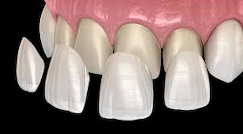 dental veneers 1