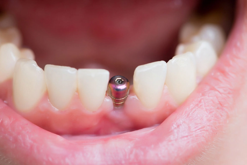 implant