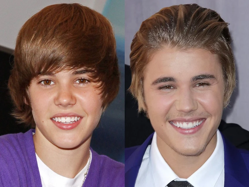 justin bieber teeth before after