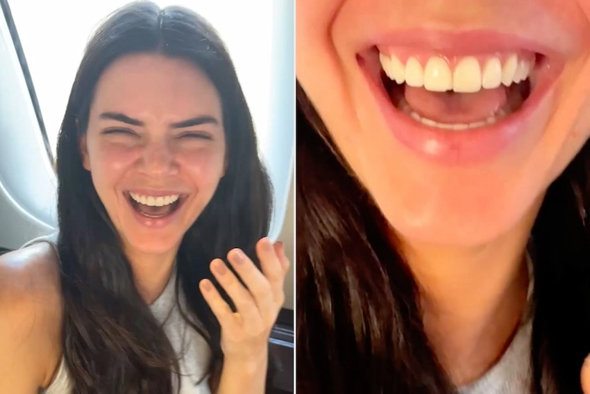 kendall jenner avant dents