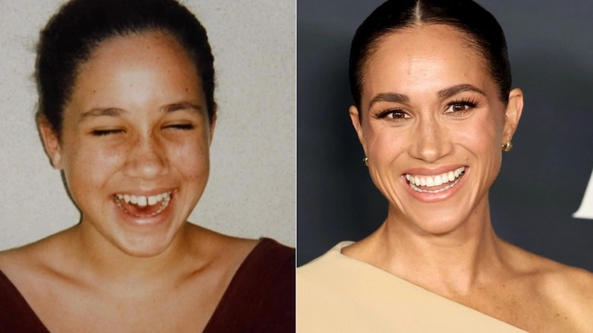 dinți meghan markle înainte