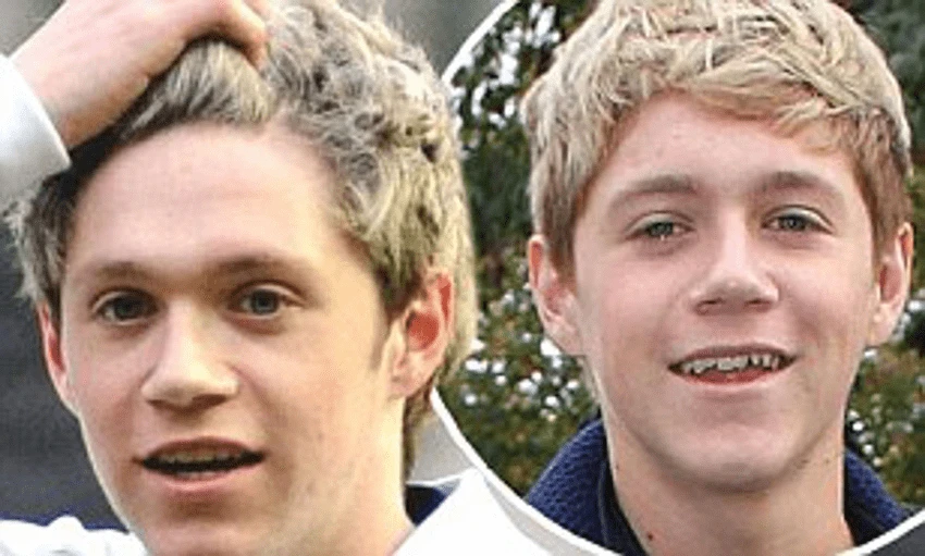 niall horan before teeth