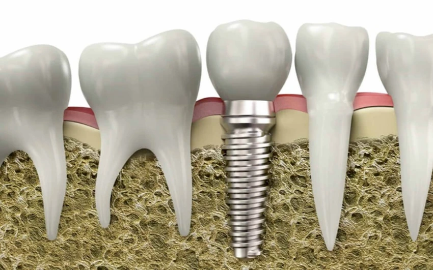 the cost of dental implants