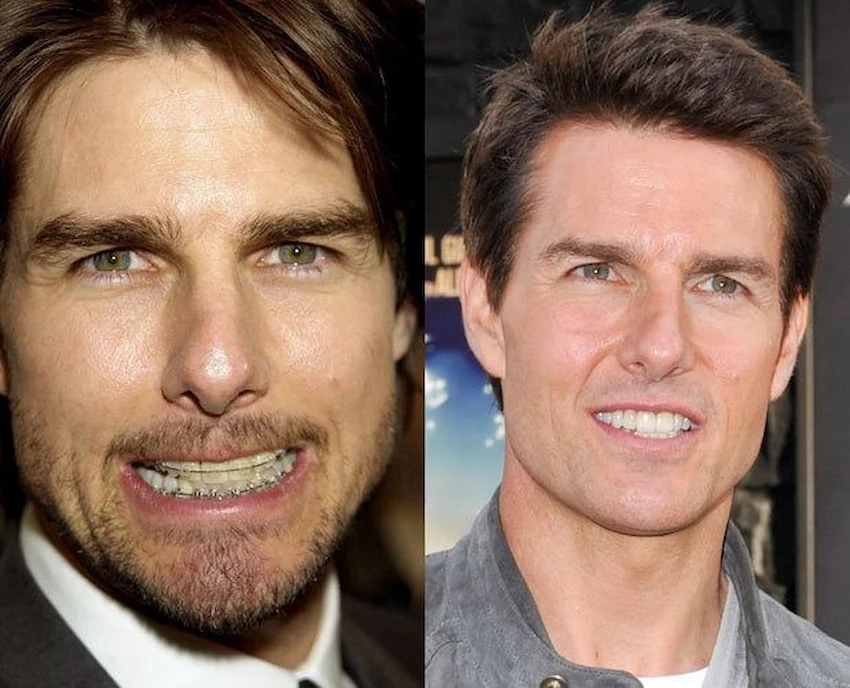 tom cruise teeth after