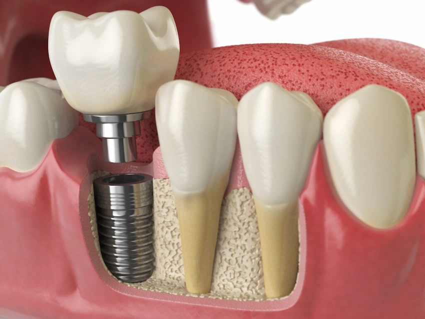 tooth implants