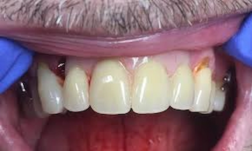 upper partial denture