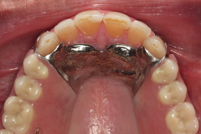 upper partial