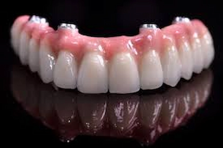 dental implants