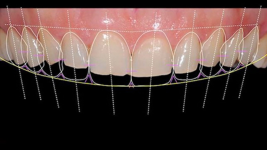 Digital Smile Design