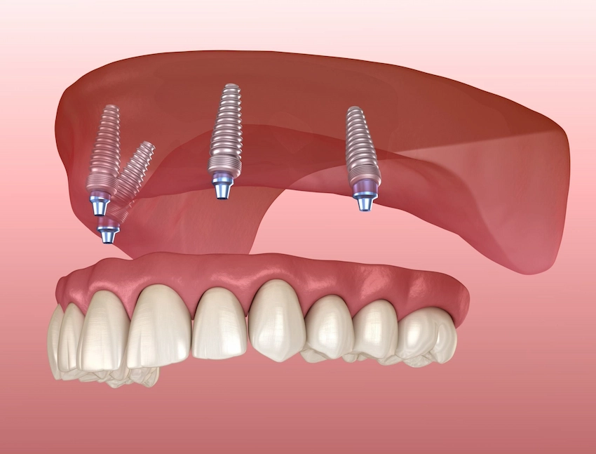 upper jaw implants