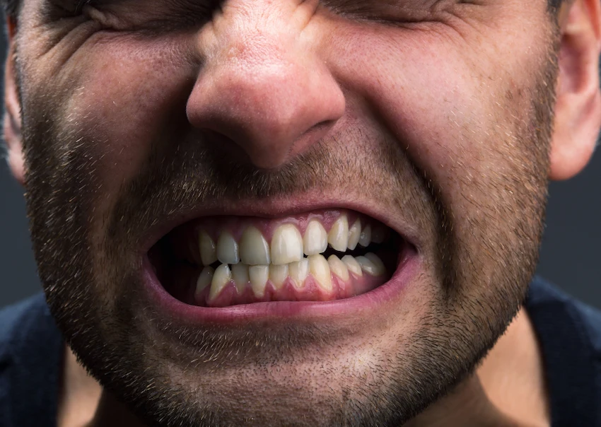 what is bruxism