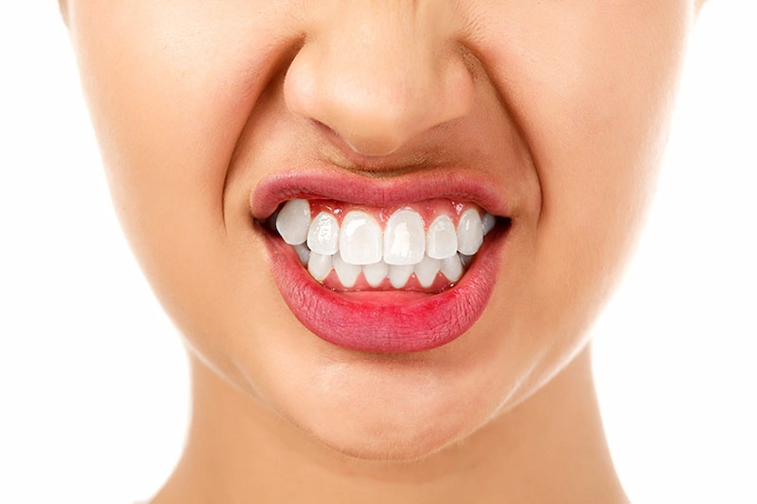 mujer con dientes de bruxismo
