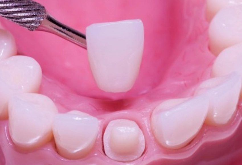 dental crown treatment