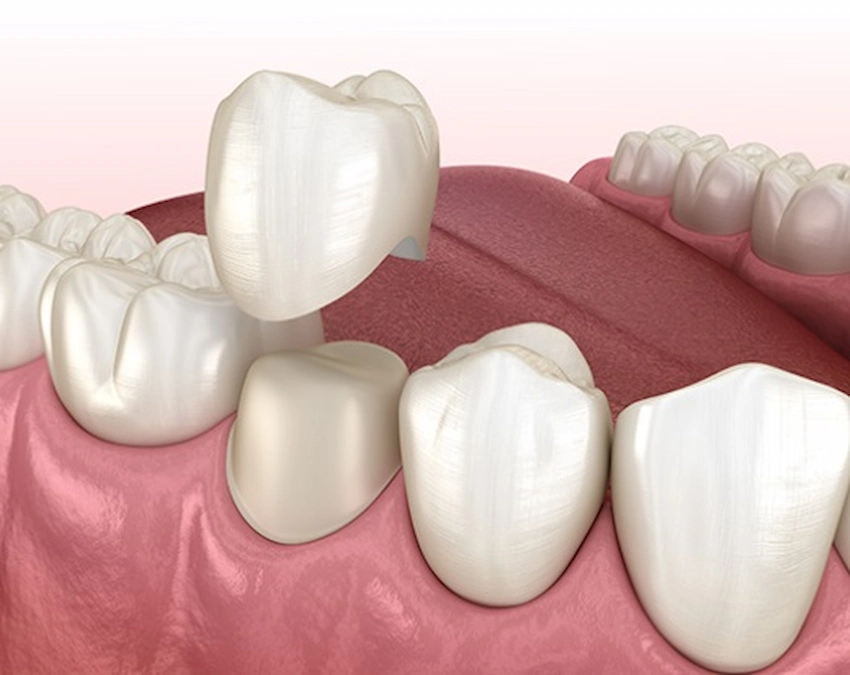 Dental Crown Procedure A Step By Step Guide Lema Dental Crown Procedure A Step By Step Guide Lema