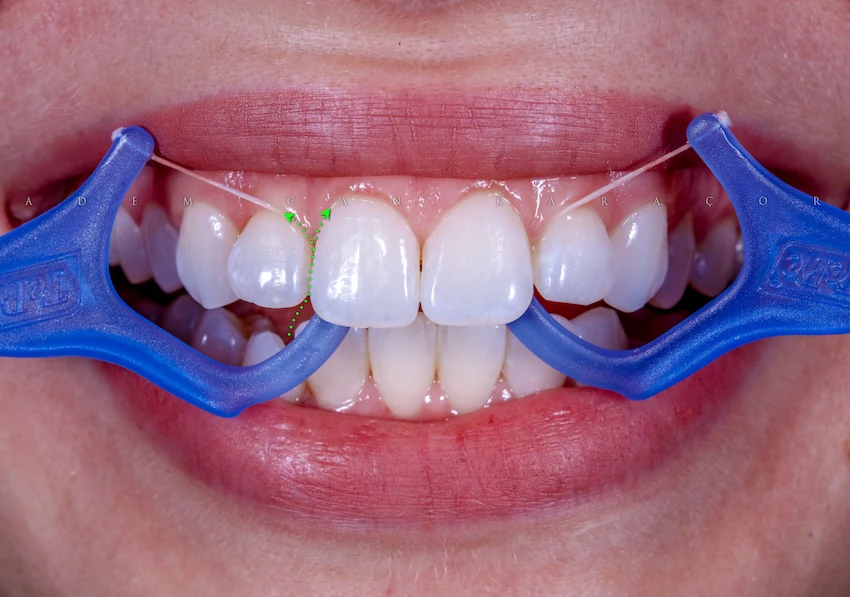 dental floss