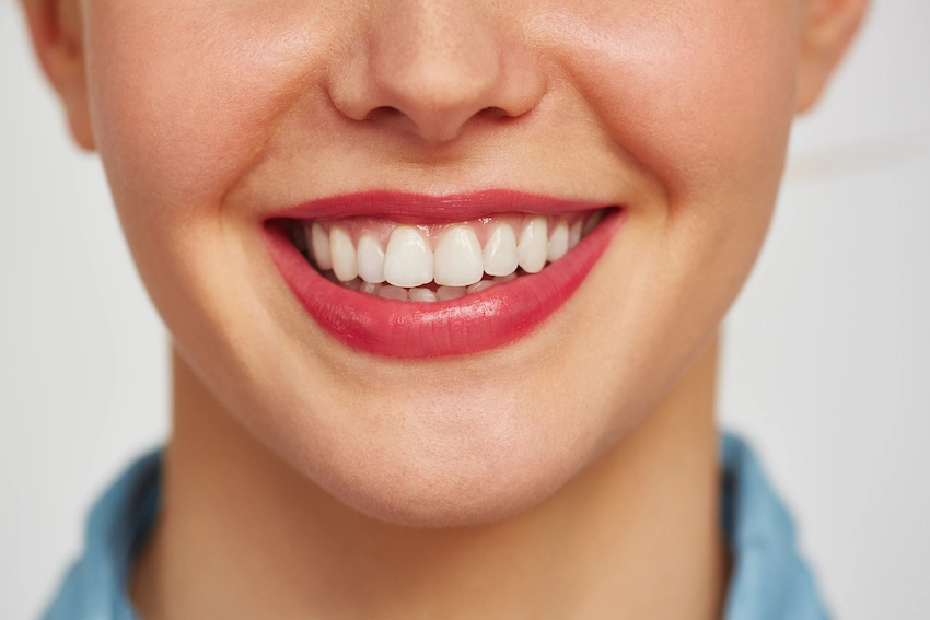 teeth bonding vs veneers