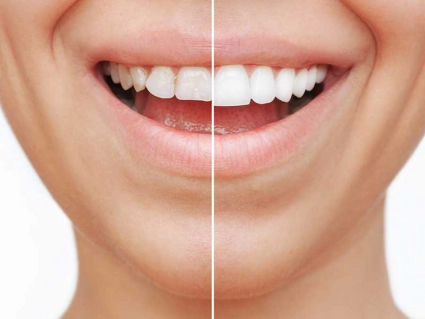 types of dental crowns and their costs