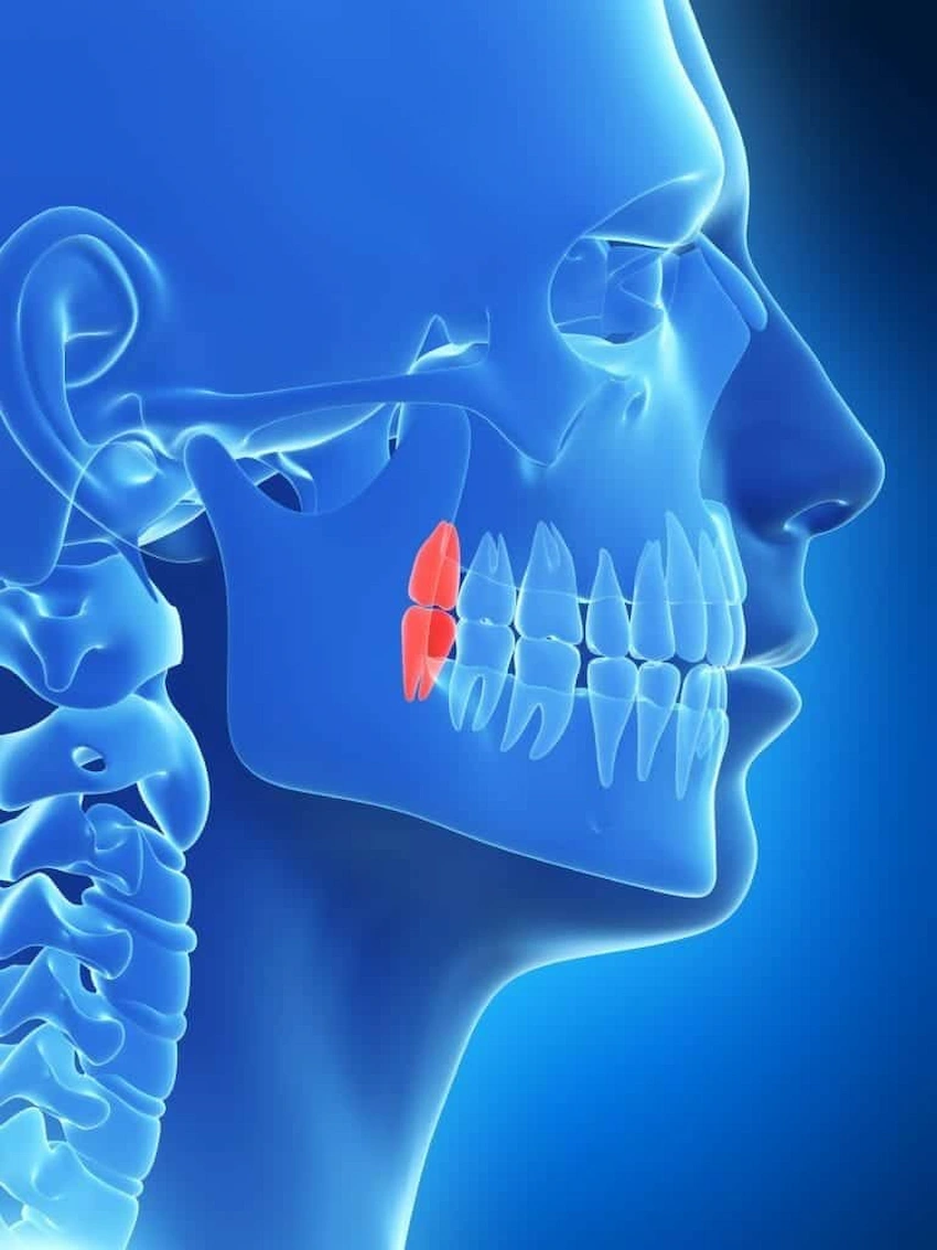 wisdom teeth
