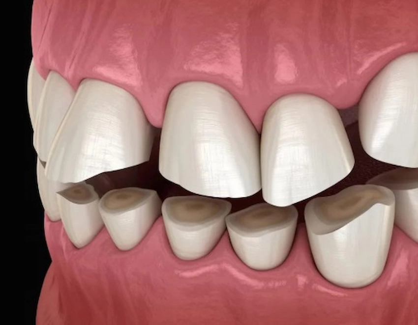 bruxism