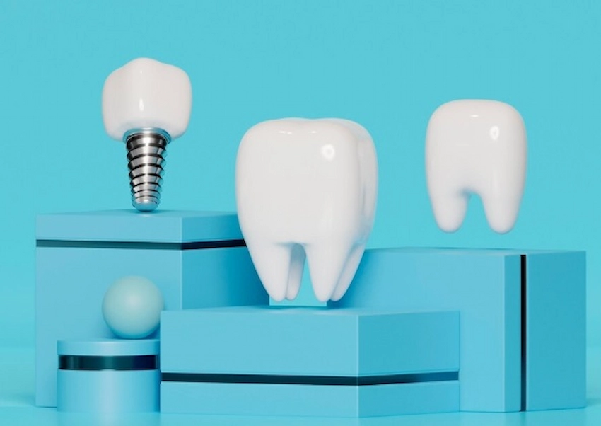 dental implants