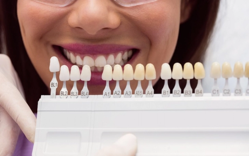 tratamiento de carillas dentales