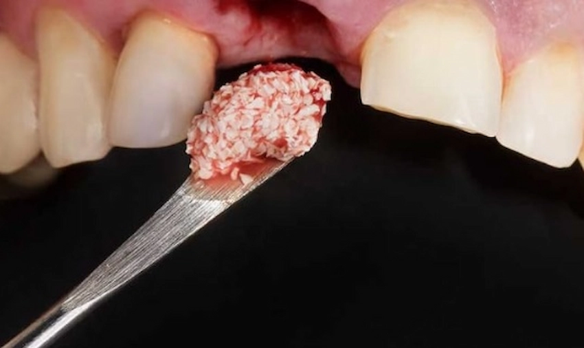 علاج زراعة العظام