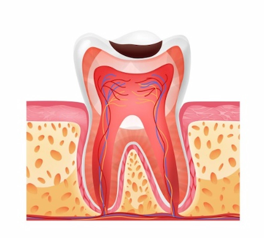 caries